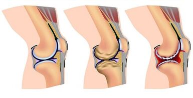 Steration nke mmepe nke arthrosis nke nkwonkwo ikpere