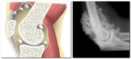 chondromatosis na mgbu na nkwonkwo hip
