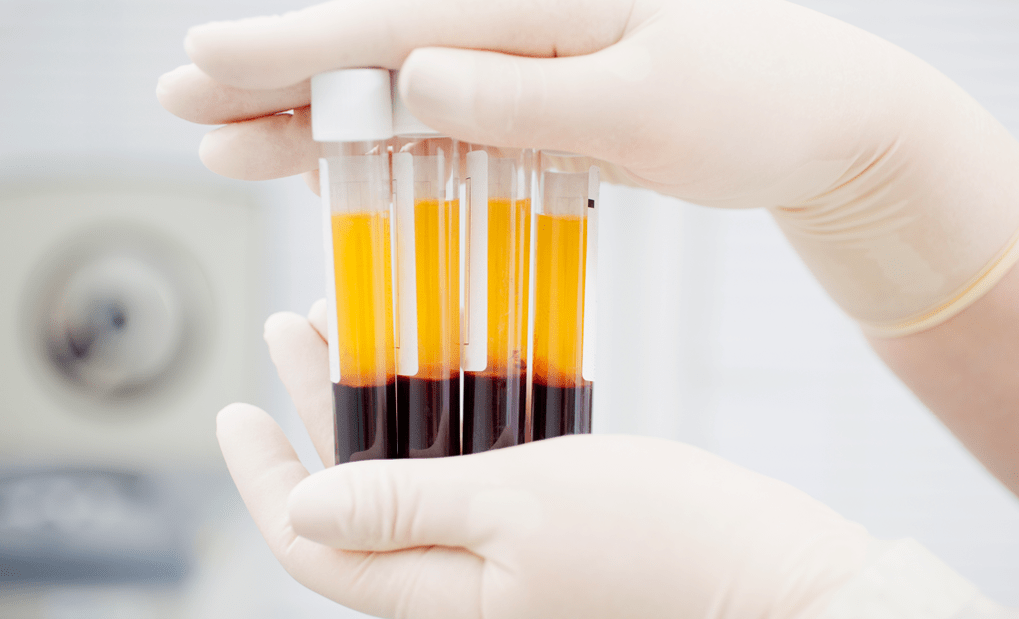 Platelet bara ụba na plasma maka ọgwụgwọ PRP maka arthrosis